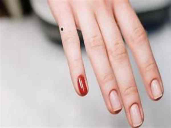 Nốt ruồi mọc ở ngón tay út là gì?