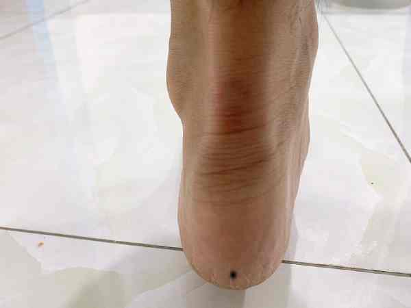 Nốt ruồi ở gót chân trái có ý nghĩa gì? Nốt ruồi ở gót chân trái có ý nghĩa gì?